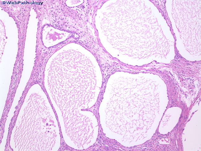 Kidney_Multilocular cystic nephroma2.jpg